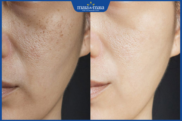 Peel da: Bí quyết sở hữu da căng bóng, mịn màng không tì vết 2 kết quả peel da