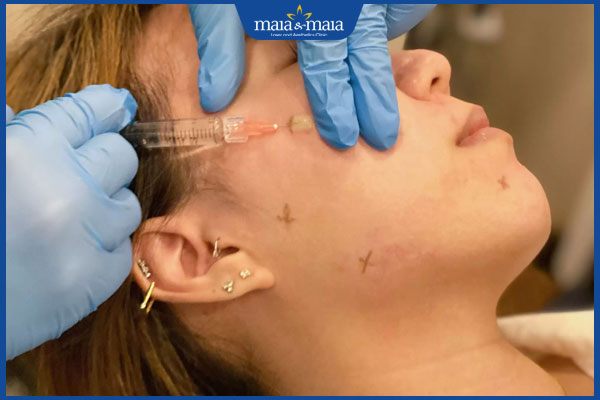 kỹ thuật tiêm bap