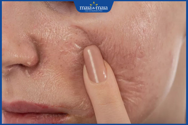 lạm dụng peel da