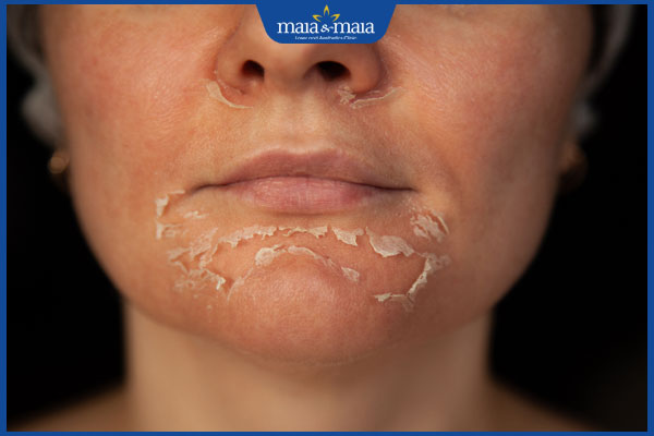 Hướng dẫn cách chăm sóc da sau peel an toàn tại nhà 2 làn da sau peel