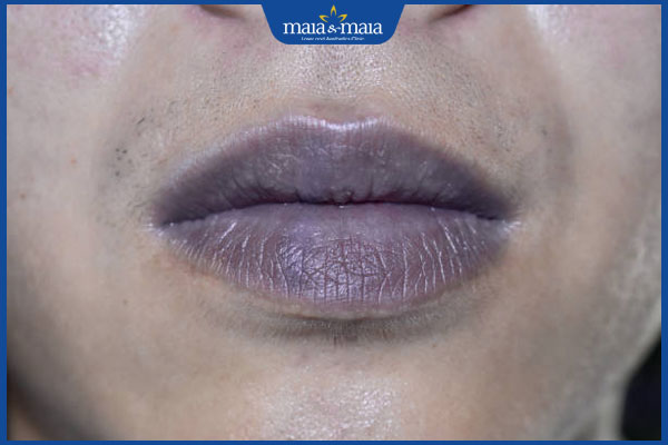 Tiêm filler môi bị nổi mụn nước có sao không? Cách xử lý kịp thời 3 môi xanh tím sau tiêm