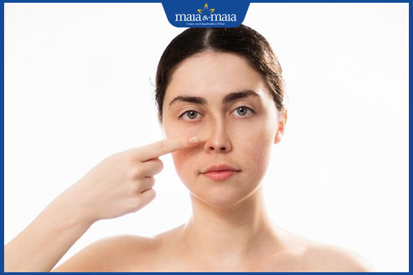 Tiêm filler mũi bị tràn có nguy hiểm không? Giải đáp từ bác sĩ chuyên khoa 2 mũi bị lệch sau tiêm filler