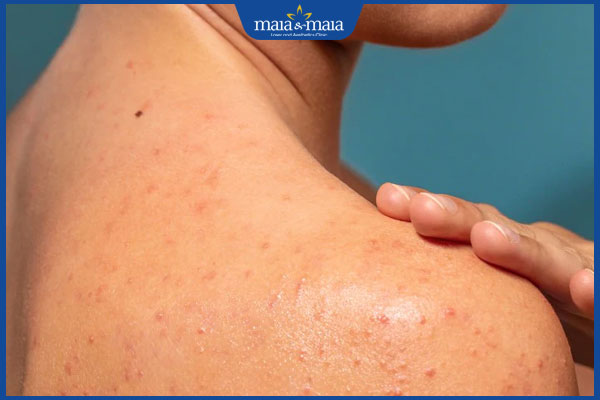 Thay da sinh học body có tốt không? Quy trình và chi phí thực hiện 3 mụn trên cơ thể