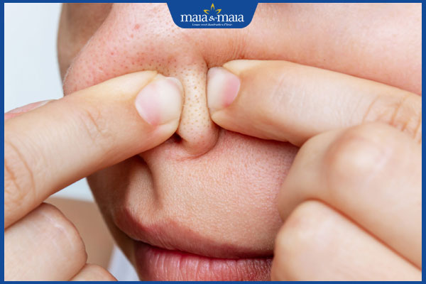 Tiêm filler mũi có được nặn mụn không? Cách xử lý mụn an toàn 2 nặn mụn mũi