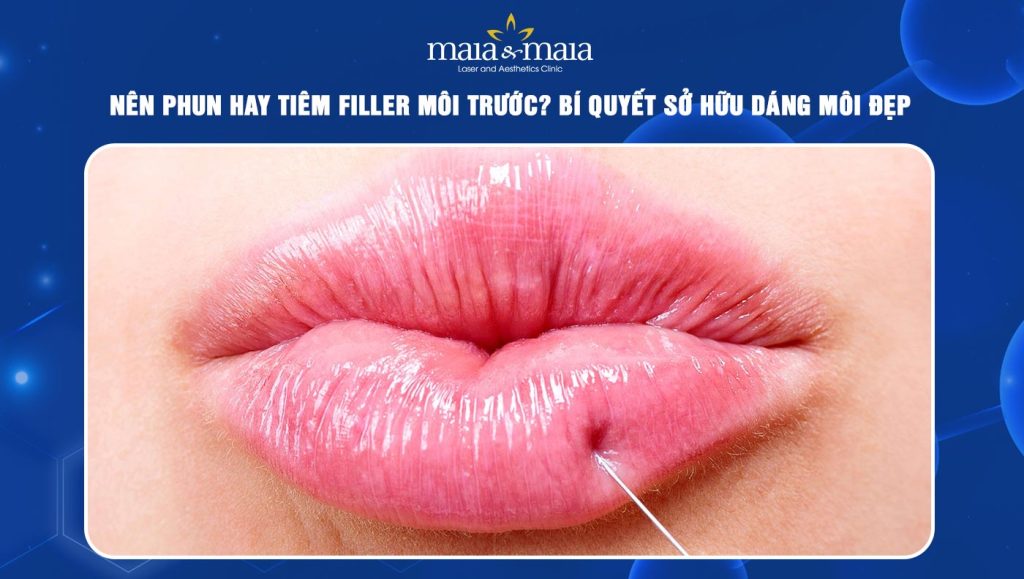 nên phun hay tiêm filler môi trước