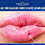 nên phun hay tiêm filler môi trước