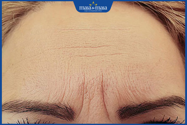 Gợi ý 5 bài tập làm mờ nếp nhăn giữa hai chân mày đơn giản tại nhà 2 nếp nhăn chân mày