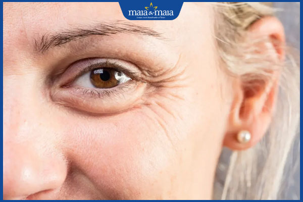 nếp nhăn ở mắt