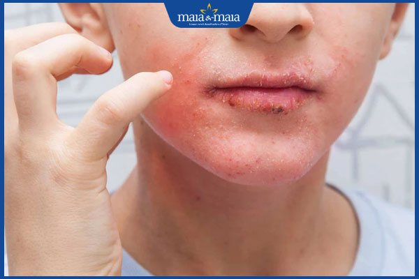 ngứa mặt sau peel da