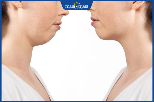 Có nên tiêm filler cằm không? Lợi ích và rủi ro tiềm ẩn khi thực hiện phương pháp này 3 người có cằm lẹm