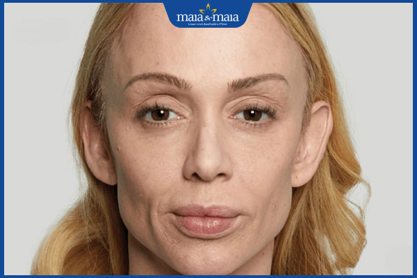 Tiêm filler má là gì? Có đắt không? Địa chỉ thực hiện uy tín 2 người má hóp