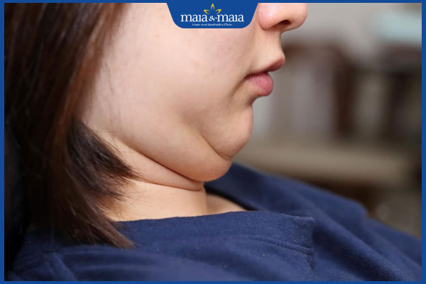 nọng cằm gây mất thẩm mỹ