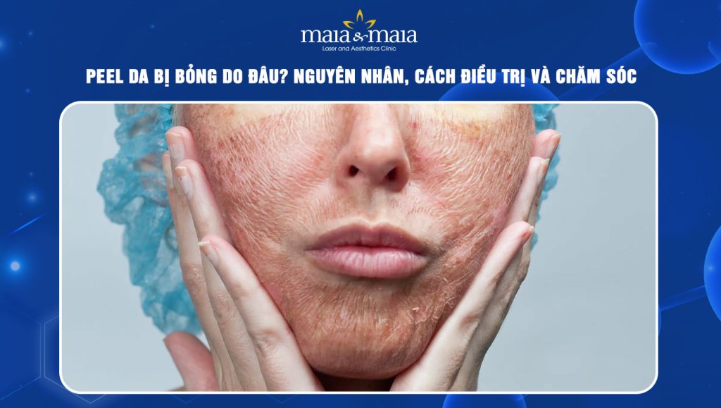 Peel da bị bỏng