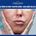 Peel da bị bỏng