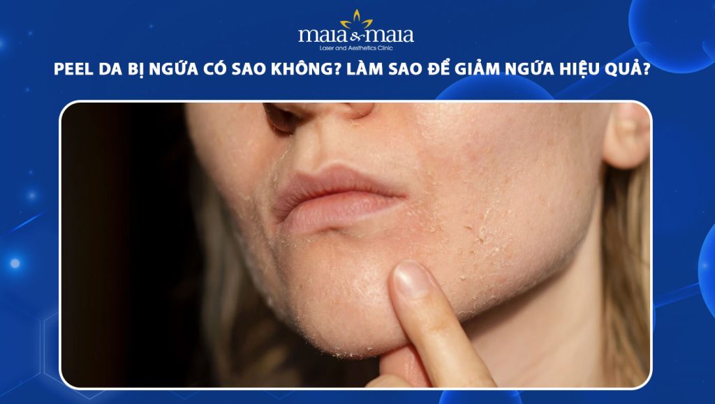 peel da bị ngứa