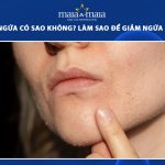 peel da bị ngứa