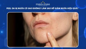 Peel da bị ngứa có sao không? Làm sao để giảm ngứa hiệu quả? 35 peel da bị ngứa