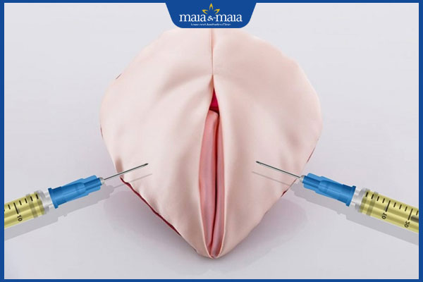 Tiêm filler vùng kín có nên không? Cảnh báo những nguy hiểm tiềm ẩn 2 phương pháp tiêm filler vùng kín