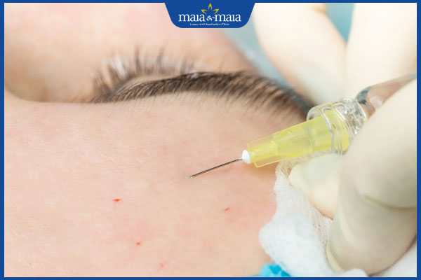 Filler siêu cứng là gì? Ai nên tiêm filler siêu cứng và lưu ý khi tiêm 4 quy trình tiêm filler chuyên nghiệp