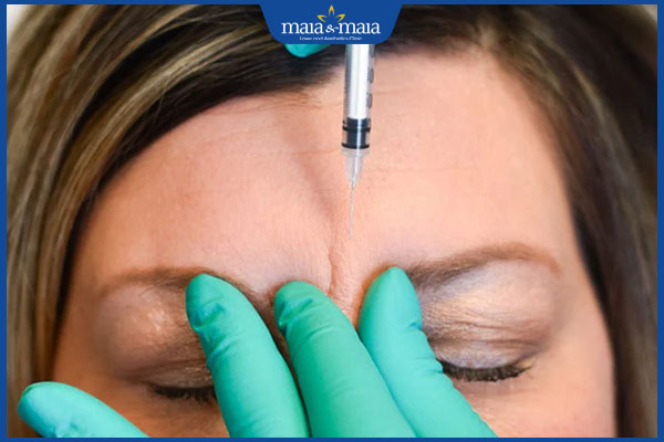 Tiêm filler ấn đường: Quy trình thực hiện và những lưu ý cần biết 5 quy trình tiêm xóa nhăn cau mày