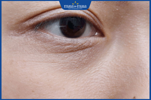 Tiêm filler rãnh lệ có an toàn không? Ai nên và không nên thực hiện? 2 rãnh lệ