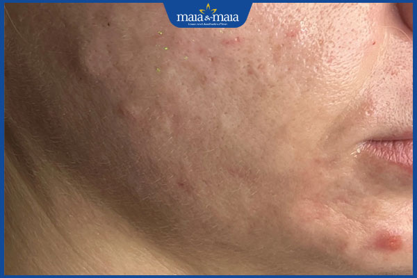 Tiêm BAP 5 điểm giá bao nhiêu? Cảnh báo nguy hiểm khi lựa chọn dịch vụ làm đẹp giá rẻ 3 rủi ro khi tiêm botox giá rẻ