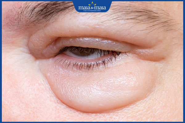 Tiêm filler rãnh lệ có an toàn không? Ai nên và không nên thực hiện? 3 rủi ro tiêm rãnh lệ