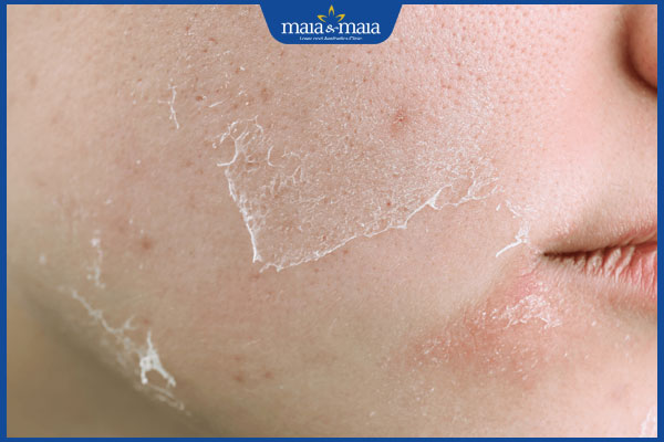 Thay da sinh học là gì? Quy trình thực hiện như thế nào? 3 tác dụng của thay da sinh học