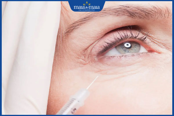 Thế nào là tiêm bọng mắt cười? Nên hay không nên thẩm mỹ vùng da dưới mắt? 4 thực hiện tiêm bọng mắt