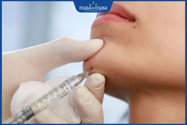 Bác sĩ giải đáp thắc mắc: Tiêm filler cằm có nặn mụn được không?  2 thực hiện tiêm filler cằm tròn