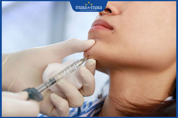 Có nên tiêm filler cằm không? Lợi ích và rủi ro tiềm ẩn khi thực hiện phương pháp này 2 thực hiện tiêm filler cằm