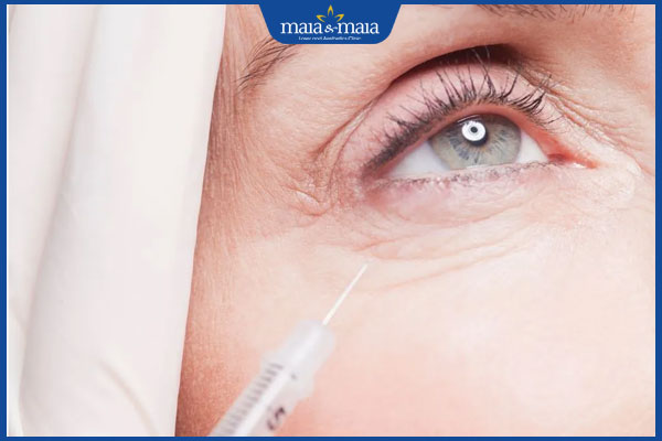 Tiêm filler hốc mắt giá bao nhiêu? Lưu ý quan trọng khi thực hiện 2 thực hiện tiêm hốc mắt