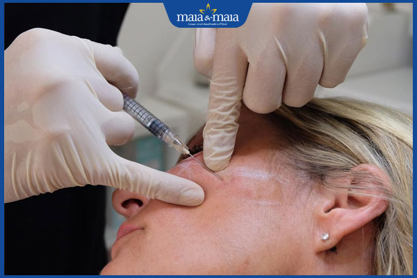Tiêm HA collagen làm đầy má có tốt không? Quy trình và chi phí thực hiện 4 thực hiện tiêm làm đầy má