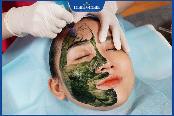 Vi kim tảo biển Ultra V có tốt không? Quy trình và chi phí thực hiện 2 thực hiện vi kim tảo biển Ultra