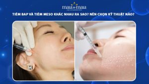 Tiêm BAP và tiêm Meso khác nhau ra sao? Nên chọn kỹ thuật nào để sở hữu da căng mịn?  68 tiêm bap và tiêm meso
