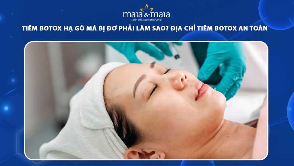 tiêm botox hạ gò má bị đơ