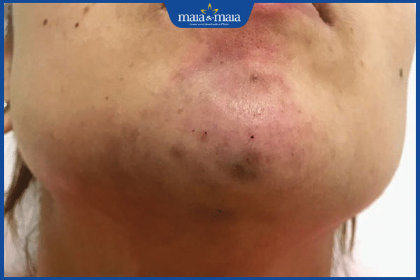 Học tiêm filler tại nhà: Xu hướng thẩm mỹ nhưng tiềm ẩn nhiều rủi ro 3 tiêm cằm bị biến chứng