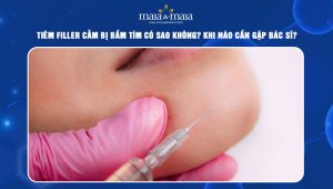 Tiêm filler cằm bị bầm tím có sao không? Khi nào cần gặp bác sĩ? 63 Tiêm filler cằm bị bầm tím