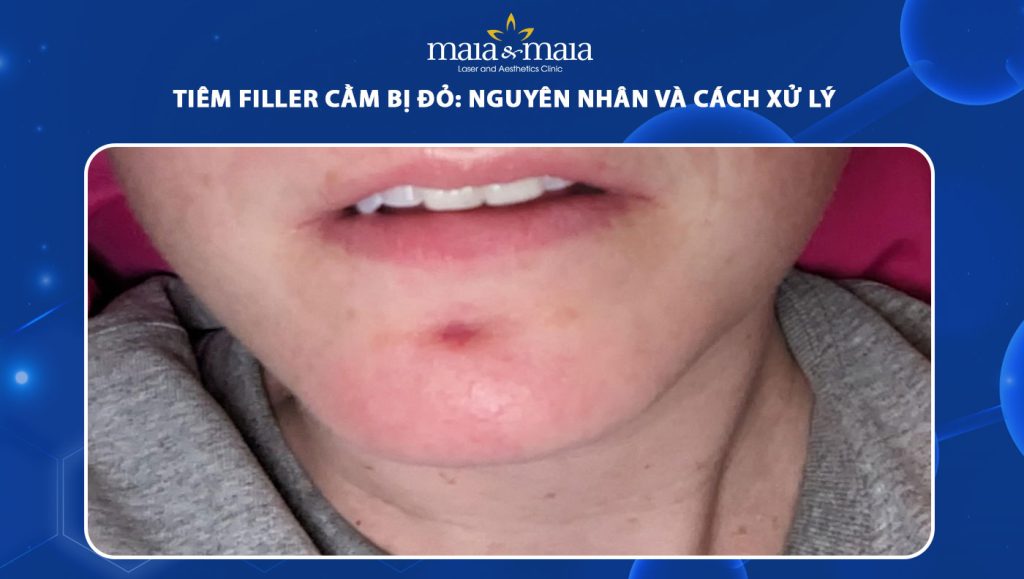 tiêm filler cằm bị đỏ