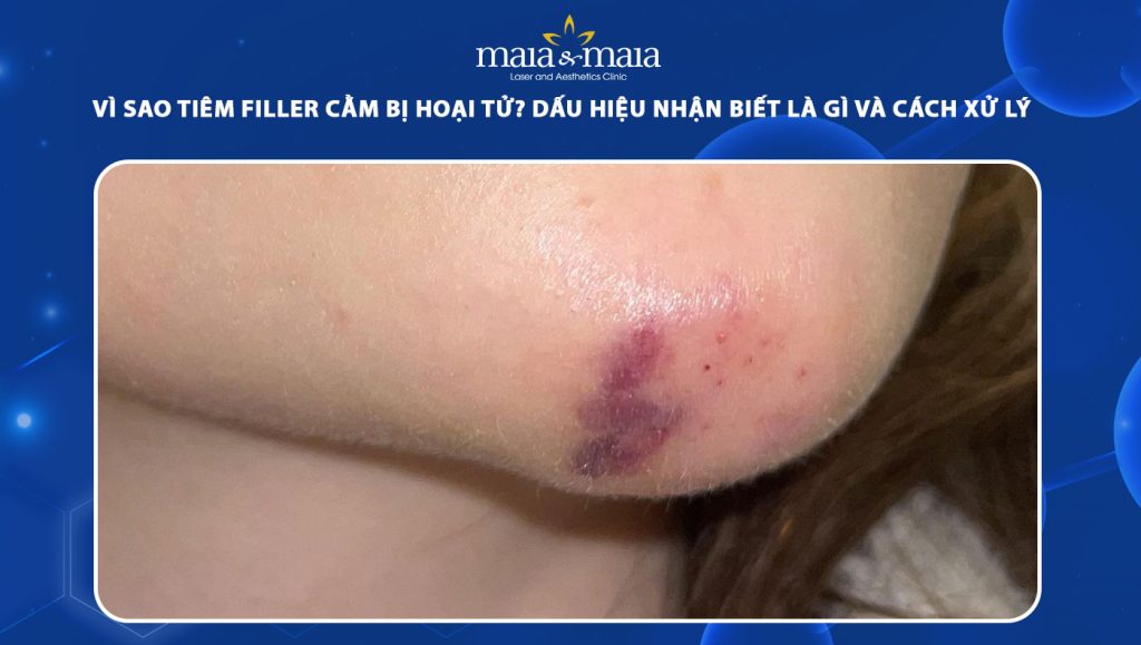 tiêm filler cằm bị hoại tử