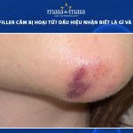 tiêm filler cằm bị hoại tử