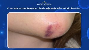 Vì sao tiêm filler cằm bị hoại tử? Dấu hiệu nhận biết là gì và cách xử lý hiệu quả  70 tiêm filler cằm bị hoại tử