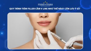 Quy trình tiêm filler cằm V line như thế nào? Cần lưu ý gì? 69 tiêm filler cằm vline