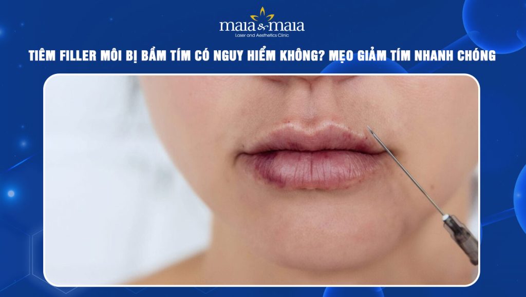 Tiêm filler môi bị bầm tím
