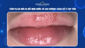 Tiêm filler môi bị nổi mụn nước có sao không? Cách xử lý kịp thời 39 tiêm filler môi bị nổi mụn nước