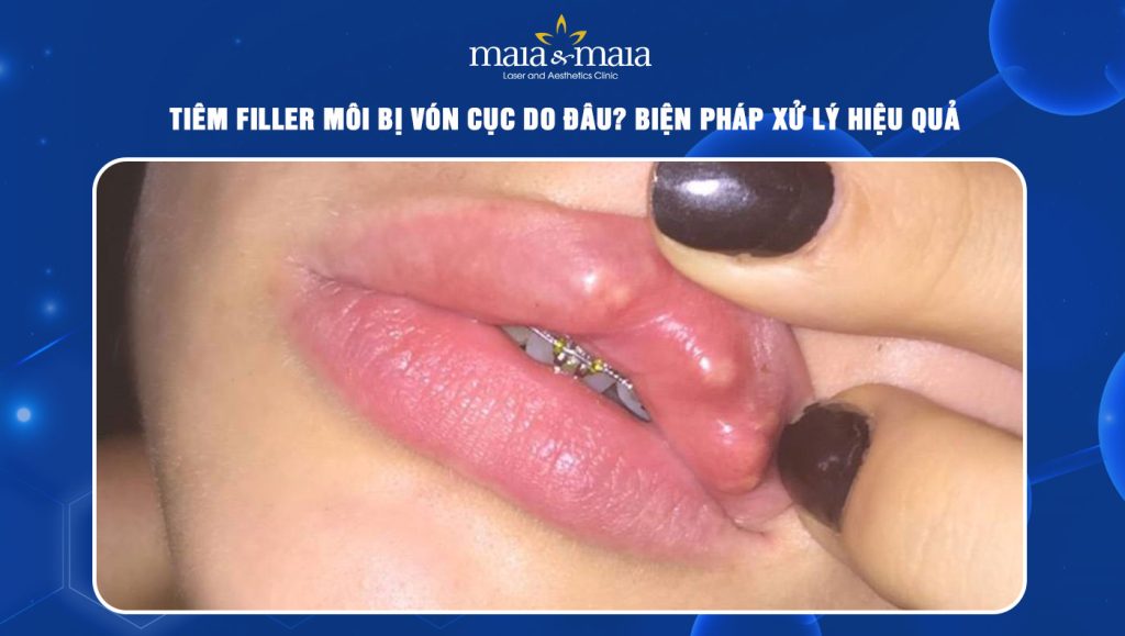 Tiêm filler môi bị vón cục
