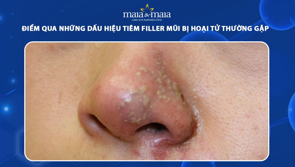 tiêm filler mũi bị hoại tử