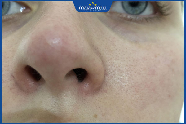 Tiêm filler mũi bao lâu hết sưng? Giải đáp chi tiết từ bác sĩ chuyên khoa 2 tiêm filler mũi bị sưng