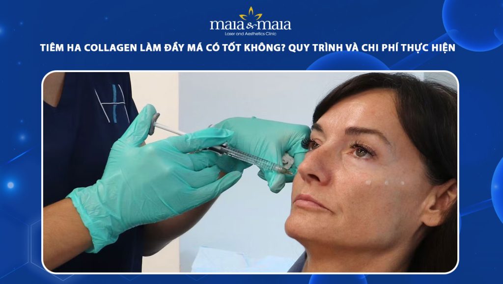 tiêm HA collagen làm đầy má