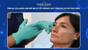 Tiêm HA collagen làm đầy má có tốt không? Quy trình và chi phí thực hiện 49 tiêm HA collagen làm đầy má